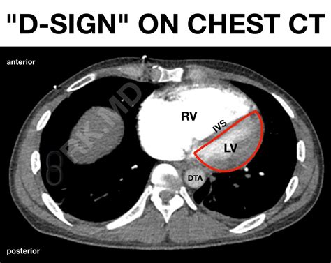 D sign (right ventricle) .